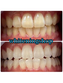 ホワイトニングショップ 吉祥寺店/BEFORE ＆ AFTER