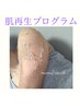 BODYのシミ改善☆ニキビケア◎ハーブピーリング(皮むけ有)¥22000→¥11000