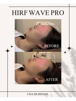 ウナ デ リンゴル 恵比寿店(UNA de Ringol)/エステ版ソフウェーブリフト