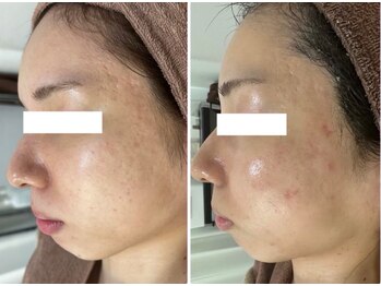 ホワイトアクア 四日市店(WHITE AQUA)/ニキビケア/ニキビ改善/美肌