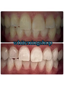 ホワイトニングショップ 大阪玉造店/Before&After美白ホワイトニング
