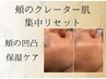 【自信のある肌へ】頬の凸凹肌　集中リセットコース初回5000(5500)