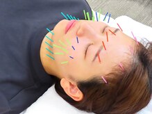 かみいけ台鍼灸整骨院の雰囲気(美容鍼で肌質改善・向上♪)