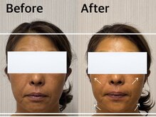 ベール(BEHL)/コルギのBefore After