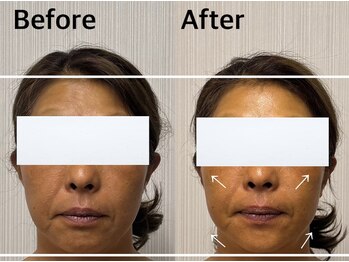 ベール(BEHL)/コルギのBefore After