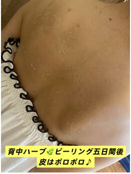 ジナ ビューティ(GINA BEAUTY)/背中ハーブピーリング