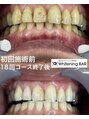 ホワイトニングバー 福島店&nbsp;#歯を白く#黄ばみ対策 #ヤニ汚れ対策#婚活準備 #就活準備