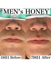 ハニーアイズ(Honey Eyes)/人気NO1ヒゲ爆抜けモード脱毛