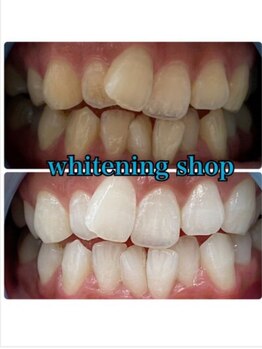 ホワイトニングショップ 京都駅前店/40分×10回Before/After