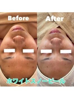 ティアラ(TIARA)/【美白、シミ、小顔】ピーリング