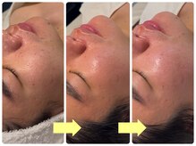 ベルドア(Bell Door)/ハーバルピーリング