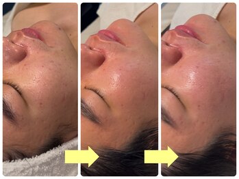 ベルドア(Bell Door)/ハーバルピーリング