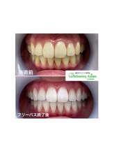 ホワイトニングサロン 名古屋駅店/【ホワイトニング施術例】