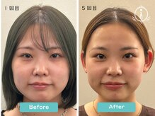 アイ(i)/ビフォーアフター