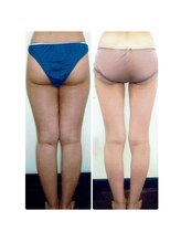 ビューティセレクト ビ プル(Be ple)/2か月後の結果