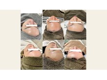 エムアイ 六本木(Mi)/ピーリング