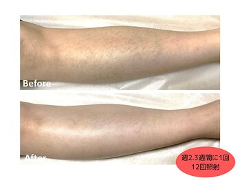 【脱毛・よもぎ蒸しサロン】Quokka/ひざ下脱毛