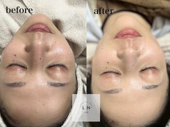ローランリム(LORAN Lim)の写真/【透明感UP☆】フェイスワックスでお顔の産毛＆古い角質を除去！ワントーン明るいツヤ美肌に♪/天文館通駅