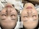 ローランリム(LORAN Lim)の写真/【透明感UP☆】フェイスワックスでお顔の産毛＆古い角質を除去！ワントーン明るいツヤ美肌に♪/天文館通駅
