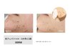 【新規】ニキビ・肌荒れが気になる方◎光フェイシャル＋美肌パック￥9,900→