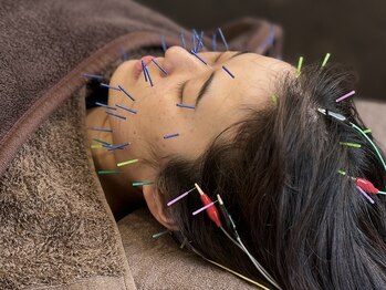 宮町鍼灸整骨院/電気を流す美容鍼