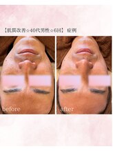 ソワイユ 浜松店(Soyeux)/肌質改善　before→after