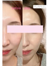 ドルチェナッツ ネオ 府内店(dolce nuts NEO)/プラピール＋ヒーライト♪