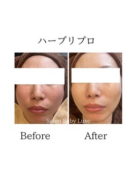サロンベイビー 西宮本店(Salon Baby)/ハーブリプロ