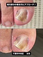 巻き爪じゅん 船橋店/根元の巻き爪に確実にアプローチ