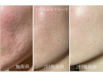 テテメルティ(te-te melty)/プロセルセラピーズ