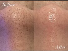 アカヌケ(AKANUKE)/いちご鼻卒業♪毛穴洗浄