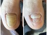 【分厚い爪の方はこちら◎】巻き爪矯正（1爪）カウンセリング込み60分　