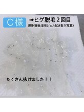 メンズー(MENZOO)/【お客様写真】ヒゲ脱毛