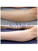 デジール(DESIR)/メンズ脱毛、部分毎にできます