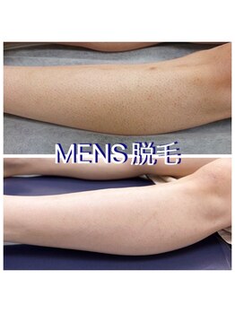 デジール(DESIR)/メンズ脱毛、部分毎にできます