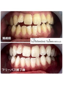 ホワイトニングサロン 京都烏丸店/ホワイトニング施術例