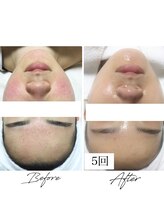 ビズビズ 梅田店(bisebise)/<症例>ニキビケア・跡・赤み