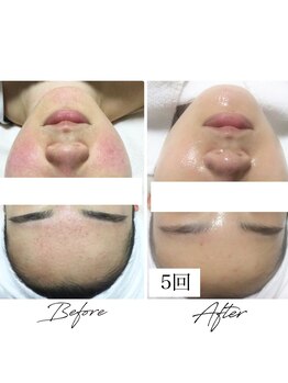 ビズビズ 梅田店(bisebise)/<症例>ニキビケア・跡・赤み