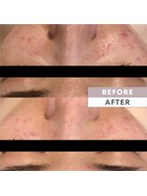 とぅるりん 肌質改善/頑固なニキビケアにも◎