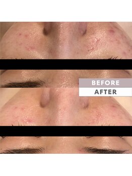 とぅるりん 肌質改善/頑固なニキビケアにも◎