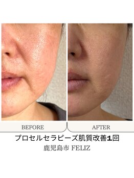 フェリス(FELIZ)/肌質改善プロセルセラピーズ