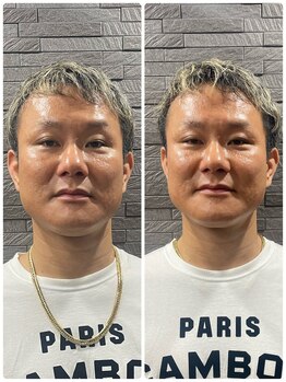 長寿鍼灸院 長寿整骨院/men's美容鍼50本効果★