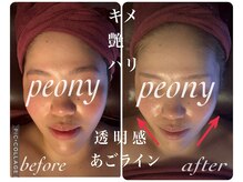 ピオニー(PEONY)/小顔 毛穴 美白 ブライダル