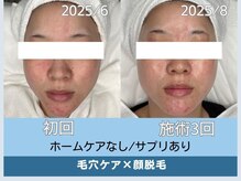 アロマ(AROMA)/凹凸跡/毛穴/越谷せんげん台