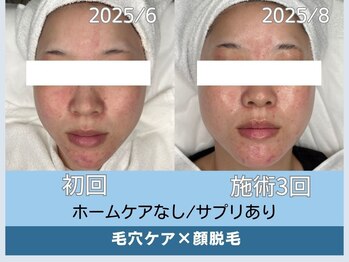 アロマ(AROMA)/凹凸跡/毛穴/越谷せんげん台