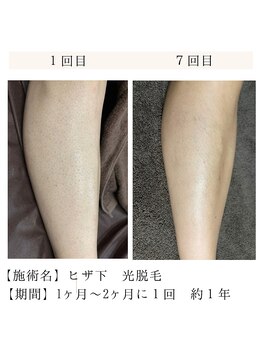 エース 赤坂/足脱毛の症例写真