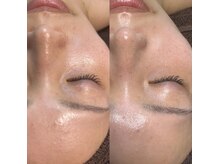 セルヴィノバ(CELL VI NOVA)/＊ビフォーアフター