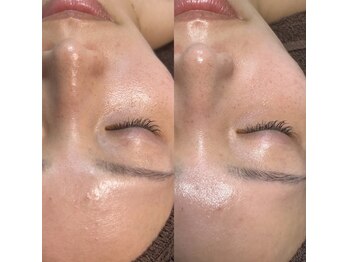 セルヴィノバ(CELL VI NOVA)/＊ビフォーアフター