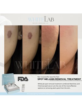 ラヌイ(LANUI)の写真/【話題のWHITE LAB】シミを改善し、若々しい印象へと導きます☆