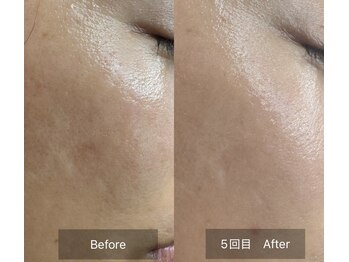 サロン ド アヤ(salon de Aya)の写真/毛穴開き・黒ずみ，シミ・くすみ，ニキビでお悩みの方へ◎根本から肌を整え，肌質改善に特化♪